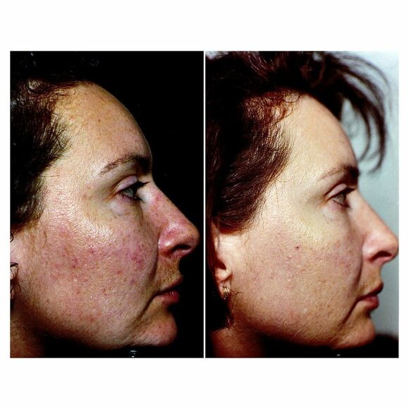 Somme Institute Exfoliating Transport Pads - Picture 6 of 13